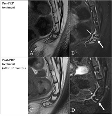 Case Report: Labor induced coccydynia associated with Modic I changes successfully treated with platelet-rich plasma